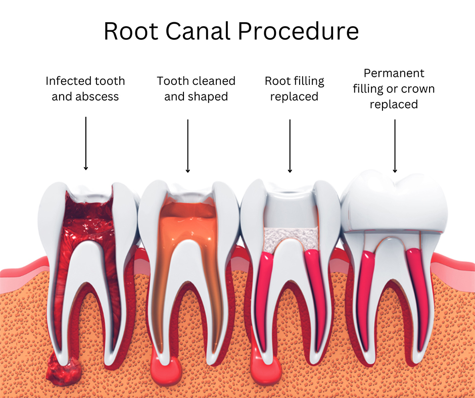 Root Canal Procedure