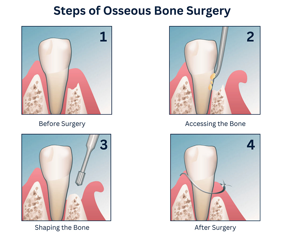 Steps of Osseous Bone Surgery
