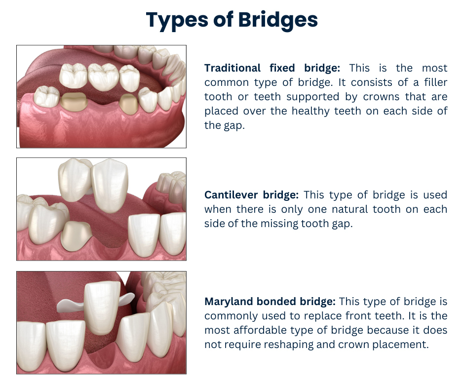 Types of Bridges