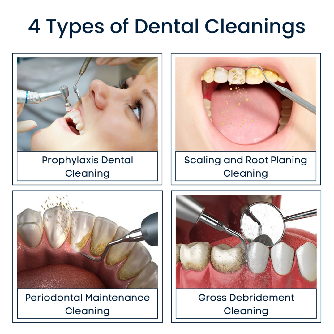 4 Types of Dental Cleanings