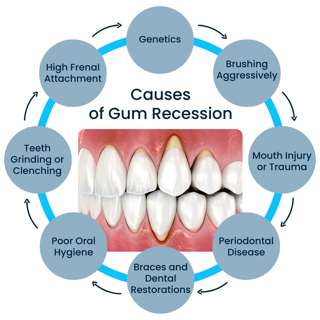 Cause of Gum Recession