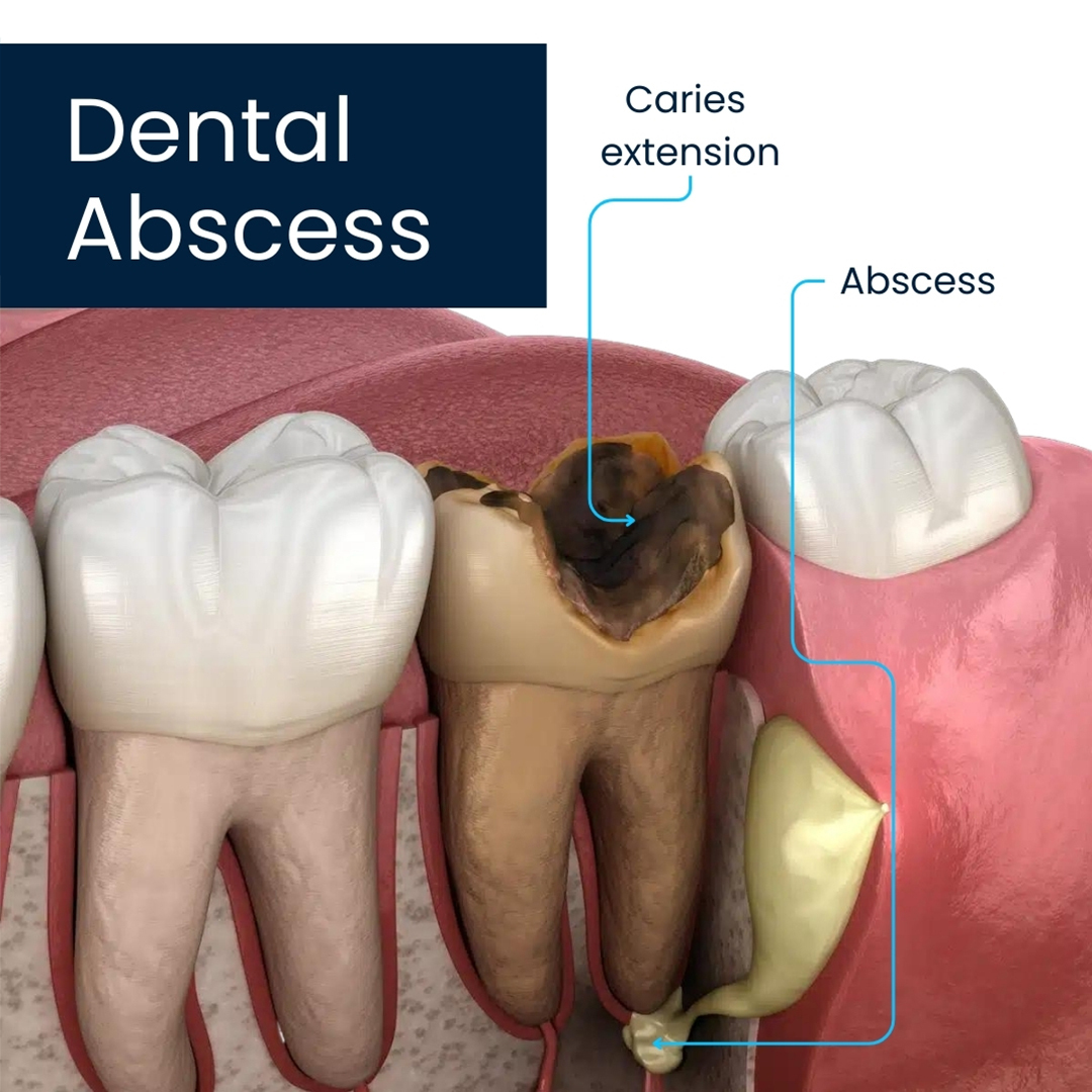 Dental Abscess