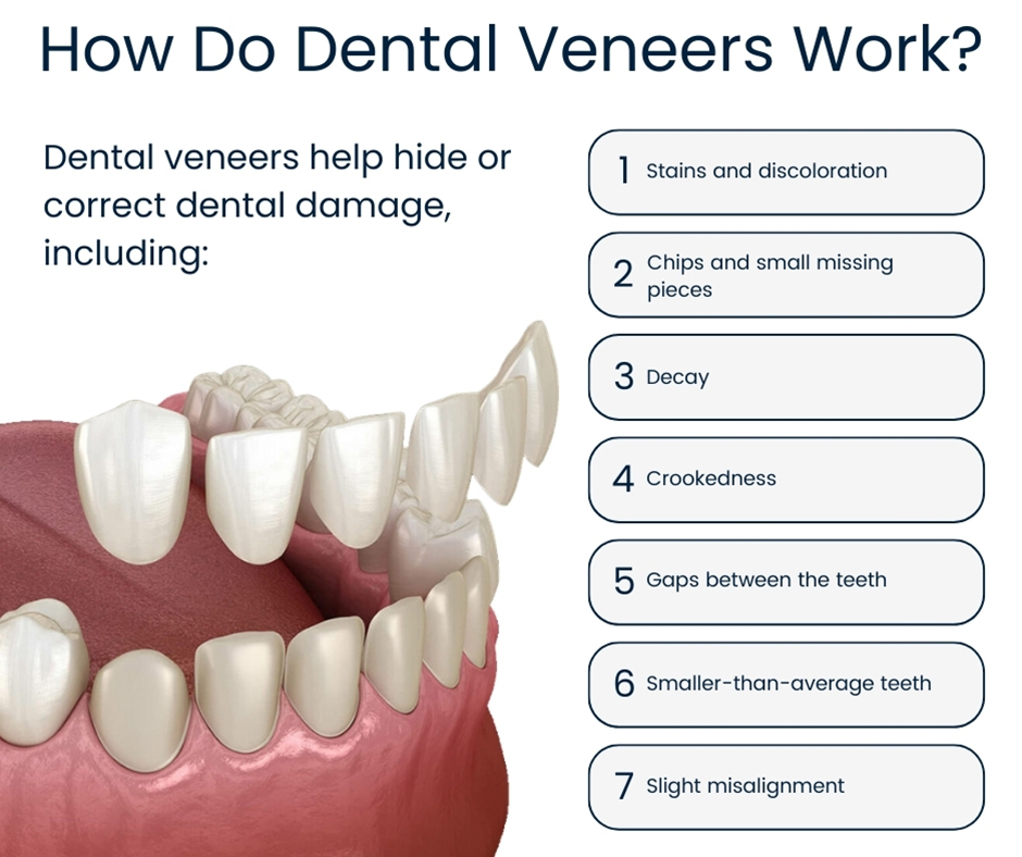 How Do Dental Veneers Work?