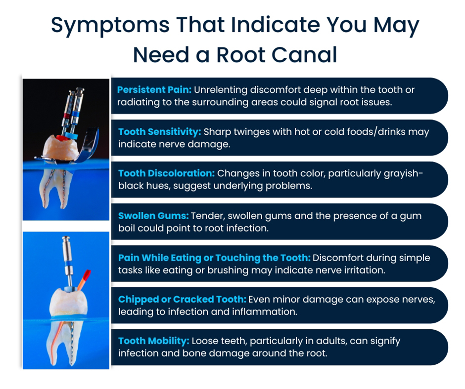 Symptoms That Indicate You May Need a Root Canal