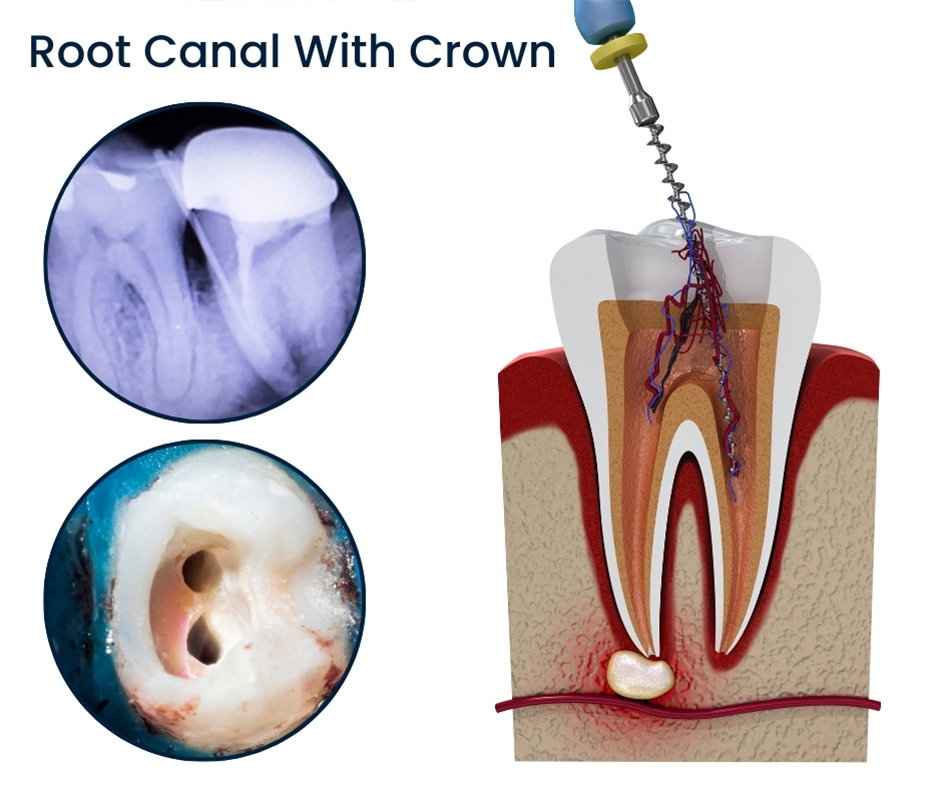Root Canal With Crown