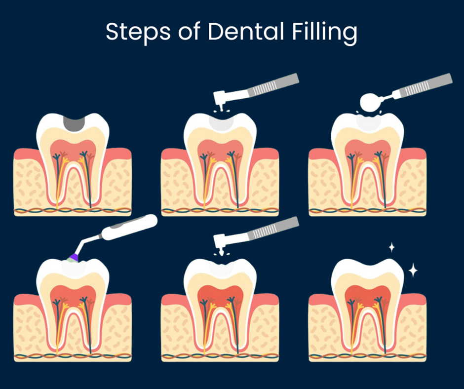 Steps of Dental Filling