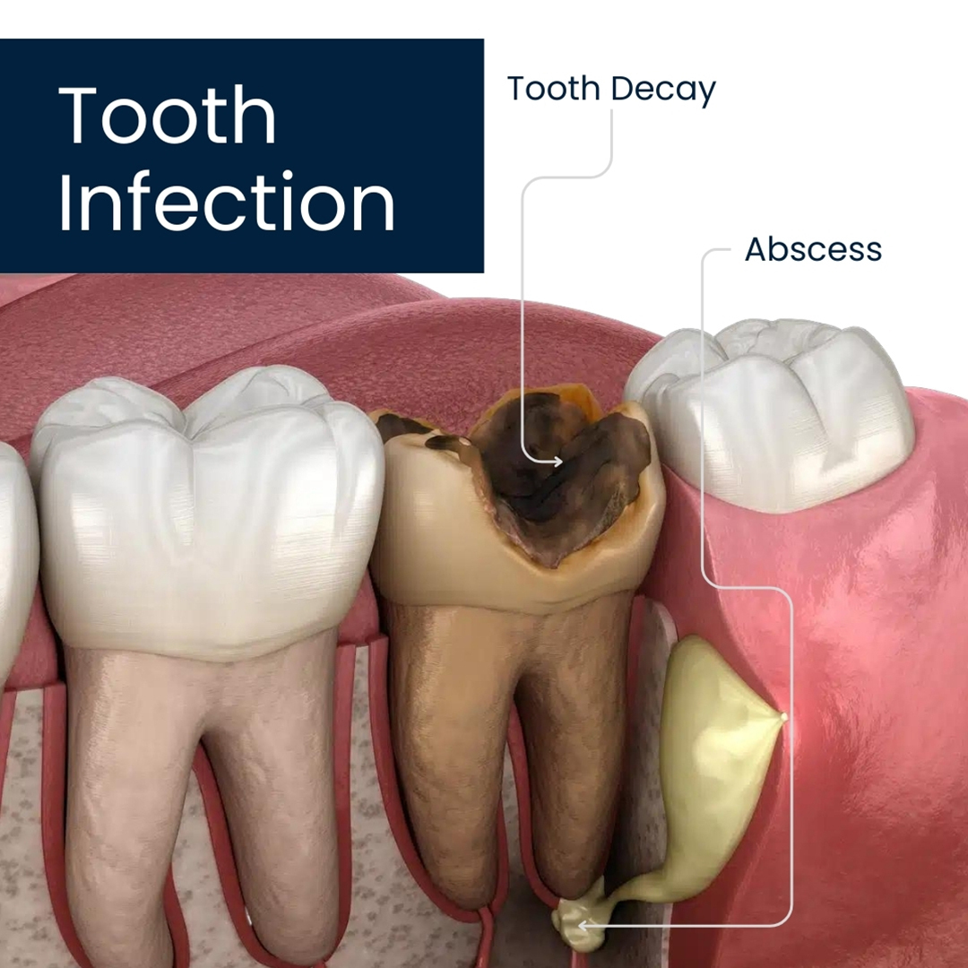 Tooth Infection
