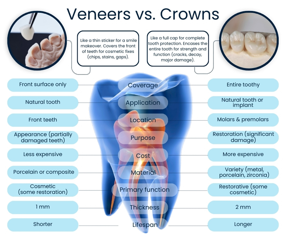 Veneers vs Crowns