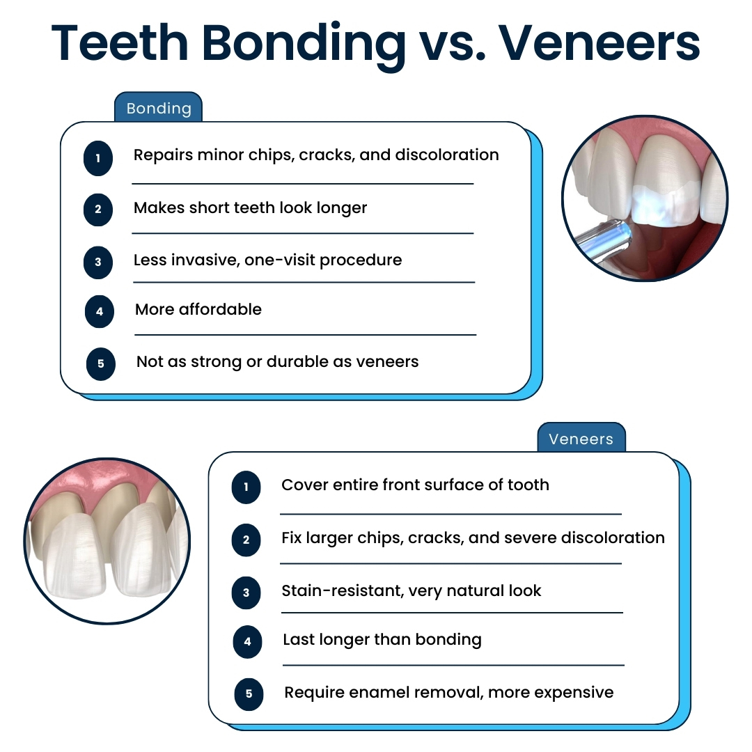 Teeth Bonding vs Veneers