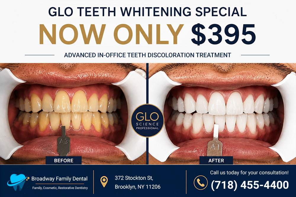 Antes Despues Blanqueamiento dental GLO en Brooklyn NY