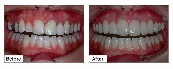 Veneers Before and After in Bushwick