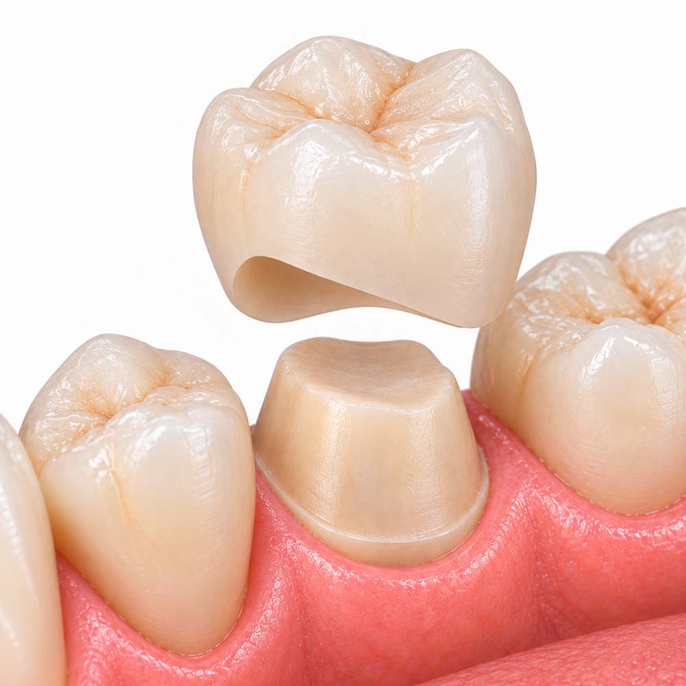 Corona dental de cerámica colocada sobre un diente preparado en Broadway Family Dental, en Bushwick, Brooklyn