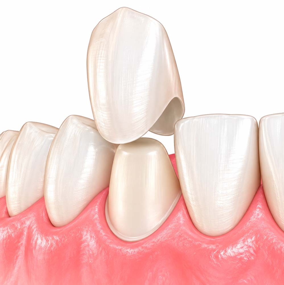 Corona dental de cerámica colocada sobre un diente preparado