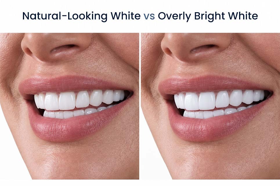 Comparación entre carillas blancas de aspecto natural y carillas de un blanco excesivamente brillante