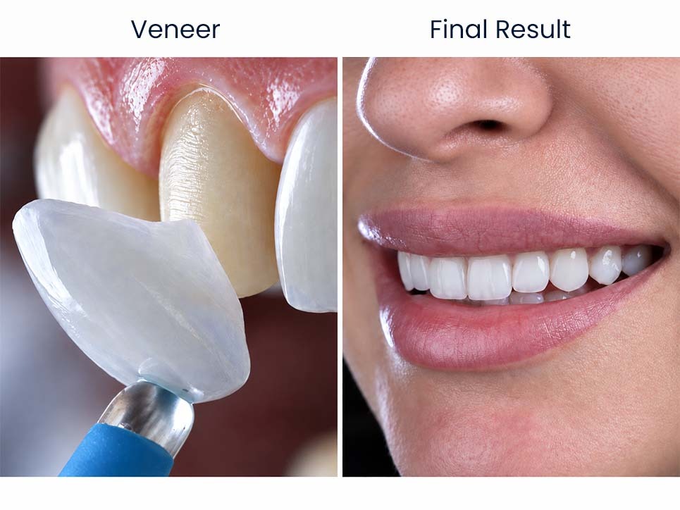 Porcelain veneer placement and finished smile result at Broadway Family Dental in Bushwick, Brooklyn