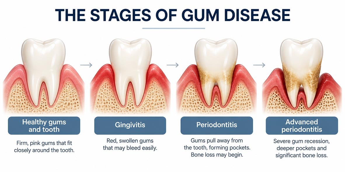 Medical illustration showing healthy gums, gingivitis, periodontitis, and advanced periodontitis, with gum inflammation, recession, and bone loss.
